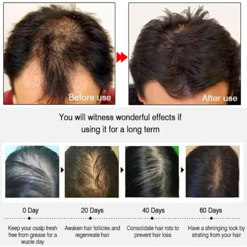سيروم نمو الشعر، كبسولات أساسي - مراجعة Ingrown Hair Serum وسعره